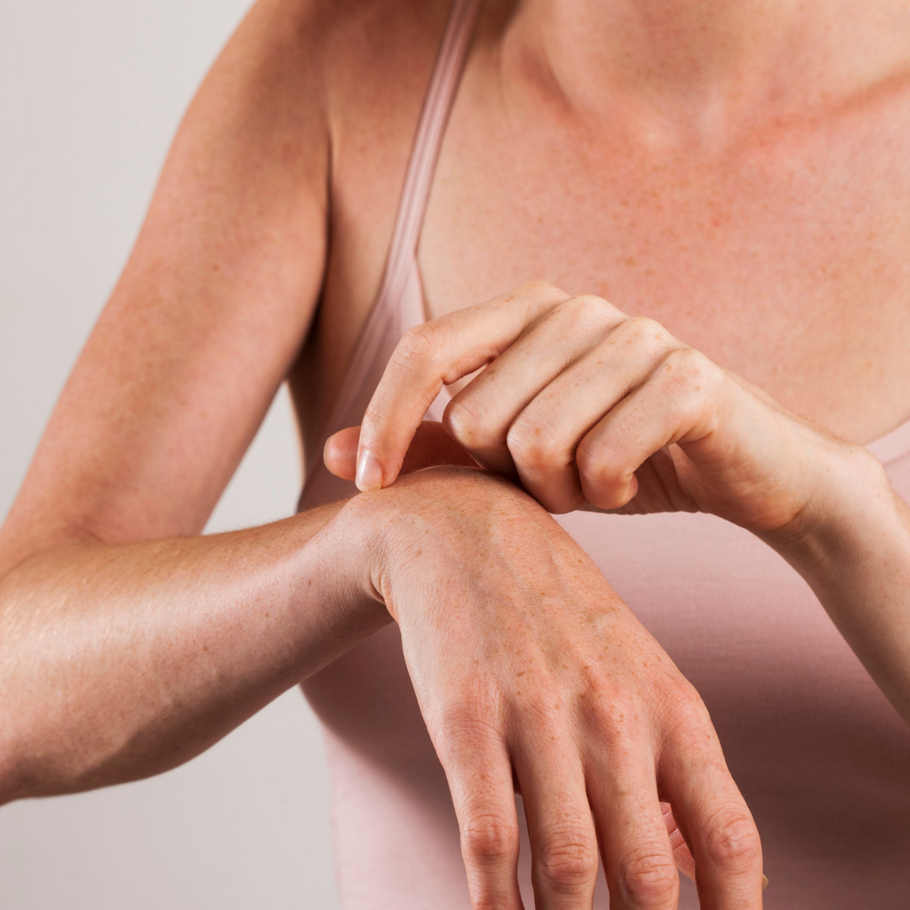 Atopic Dermatitis