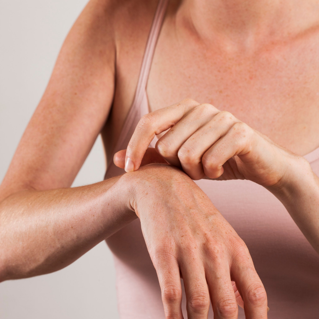Atopic Dermatitis