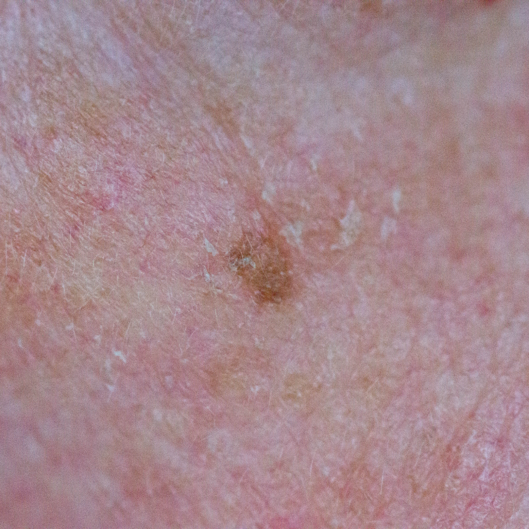 Seborrheic Keratosis