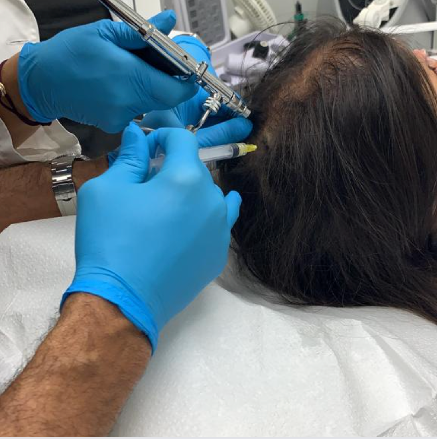 PRP Hair Treatment & Hair Loss