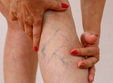 Sclerotherapy