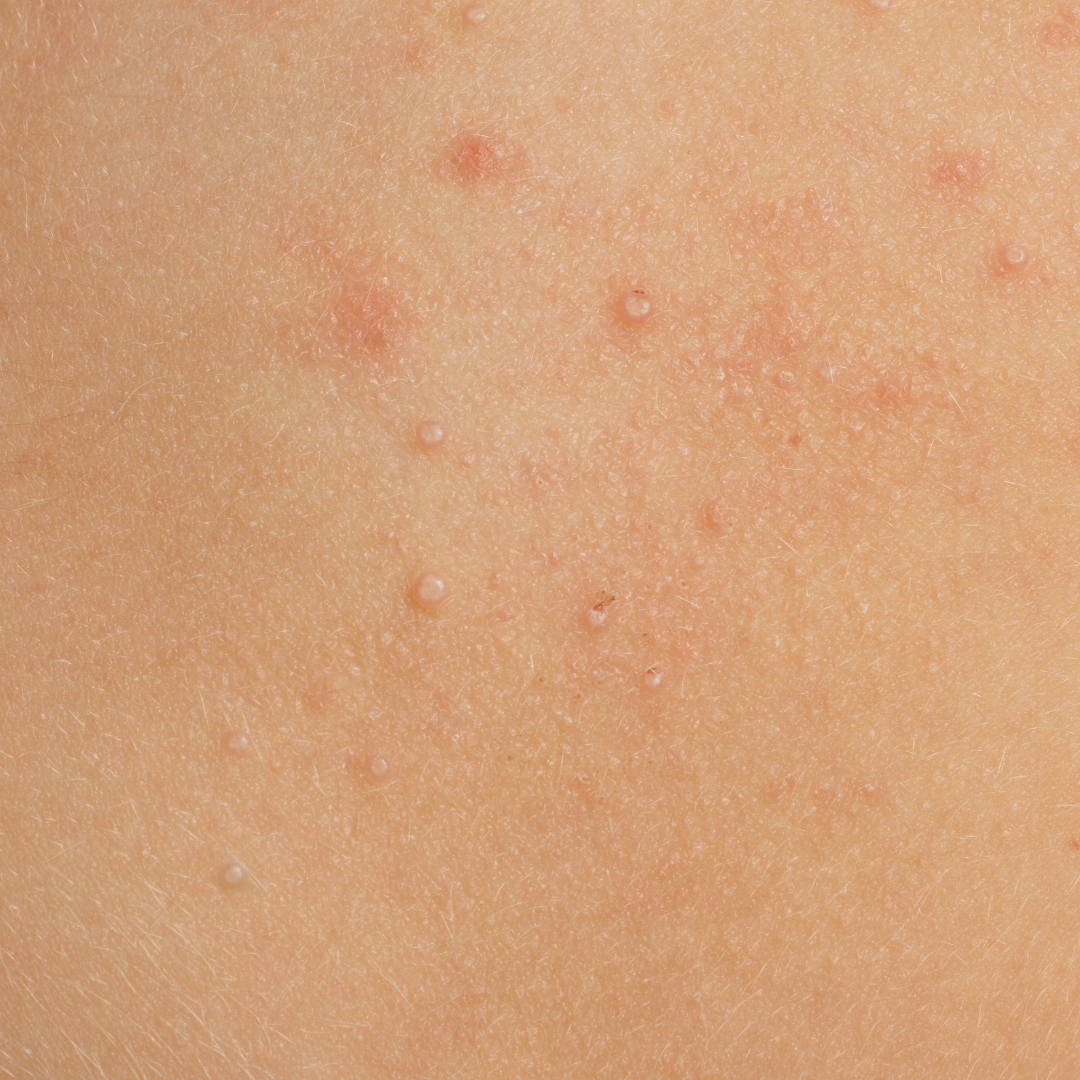 Melosicum Rash Molluscum Contagiosum