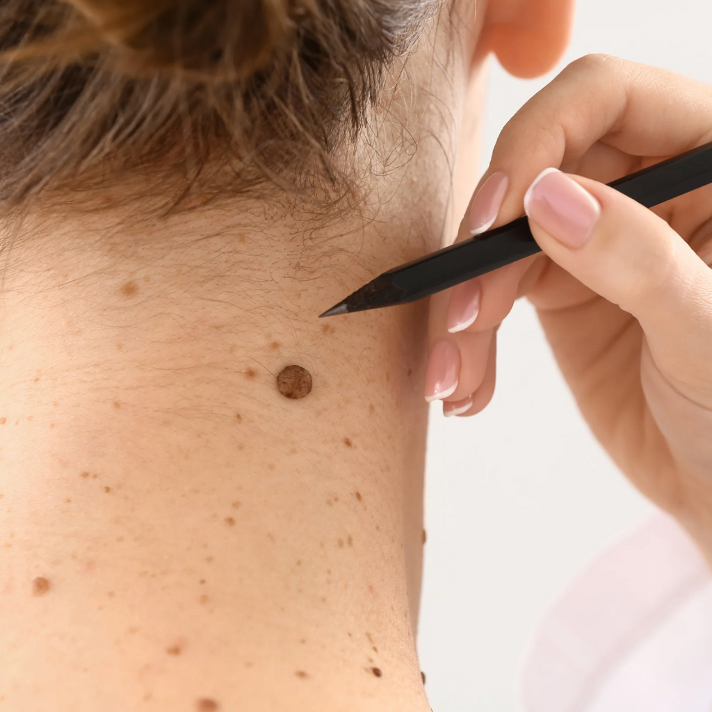Moles & Skin Lesions
