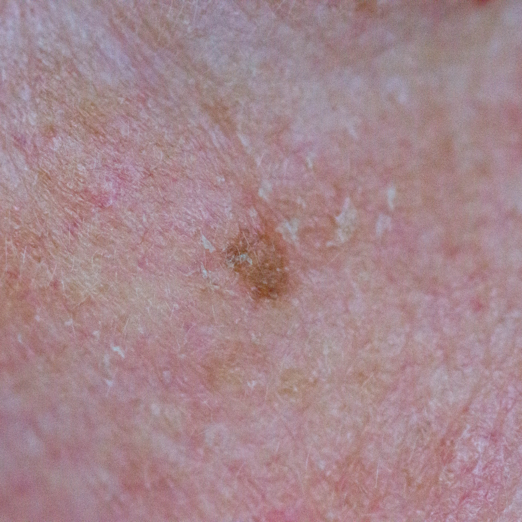 Seborrheic Keratosis