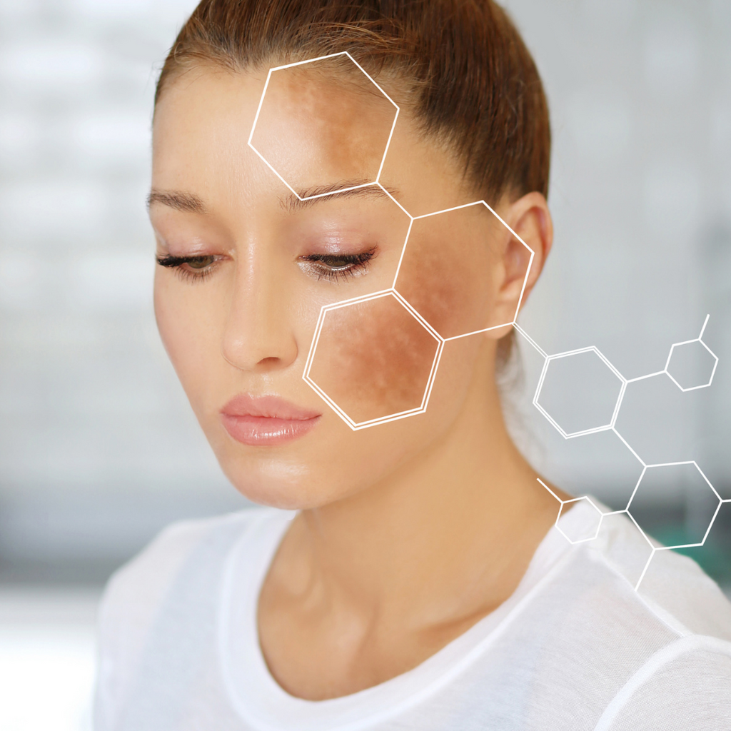 Hyperpigmentation