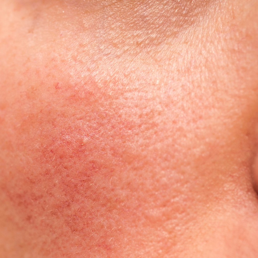 Rosacea