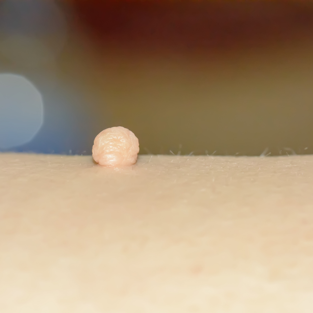Hpv Skin Tags Pictures
