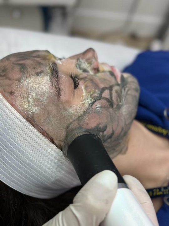 Acne Facial For Teens