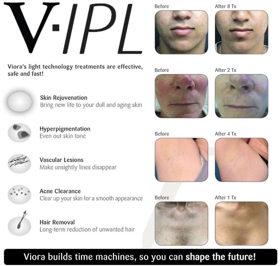 Viora V-IPL | Intense Pulse Light Therapy